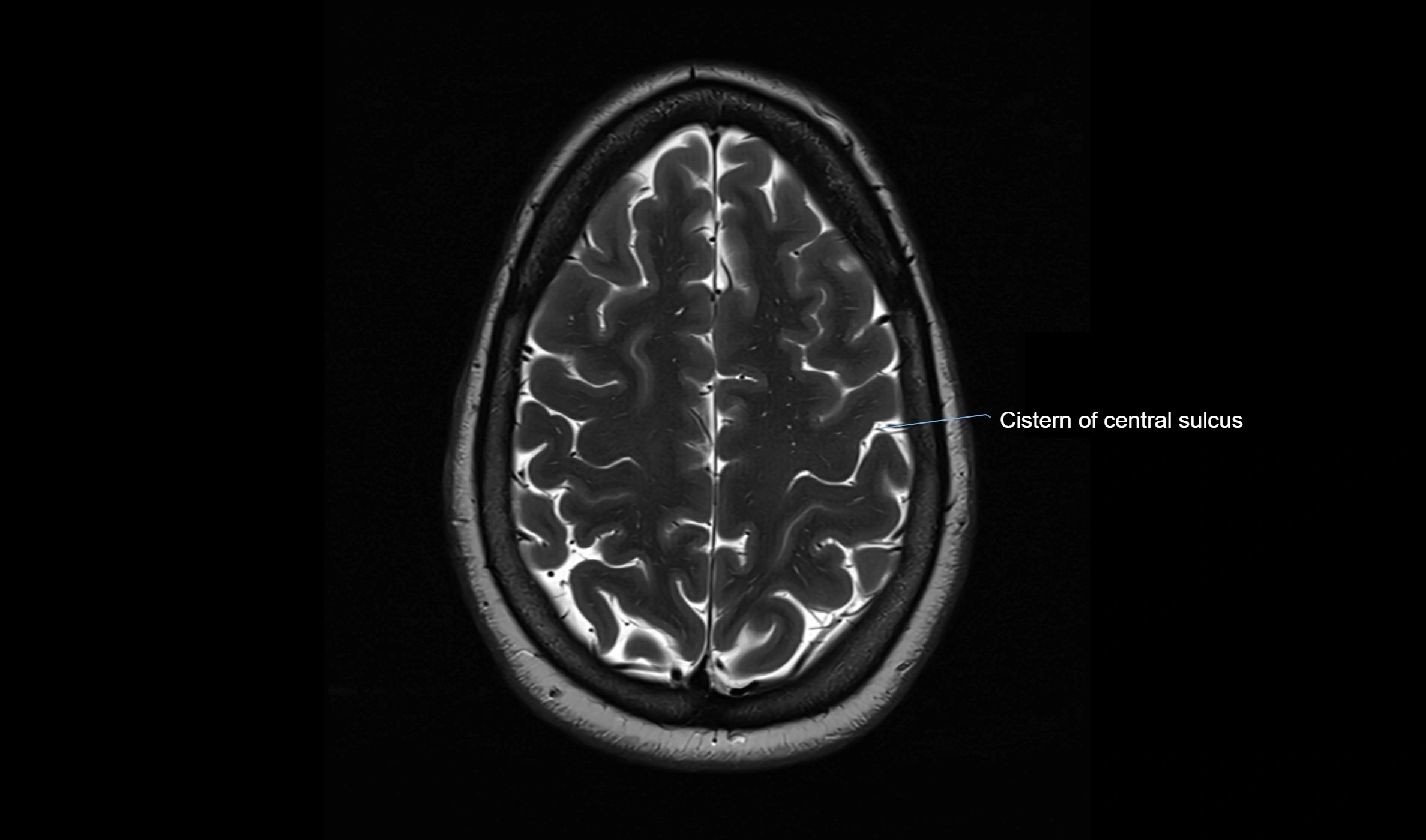 Brain cisterns  and ventricles  axial anatomy 3T MRI image-img-00001-00046.webp